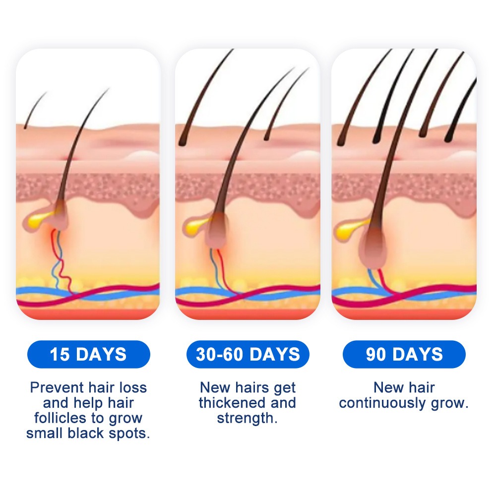 Alopecia Spray para el crecimi - Hair Care Cream reseña y precio